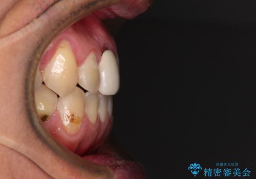 前歯のデコボコとクロスバイトをインビザライン矯正で改善の治療後