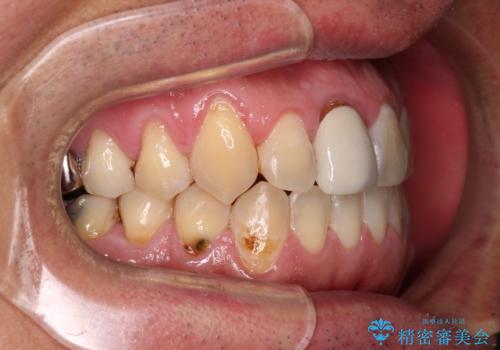 前歯のデコボコとクロスバイトをインビザライン矯正で改善の治療後
