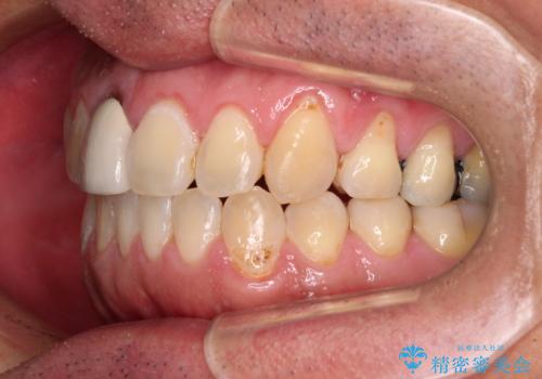 前歯のデコボコとクロスバイトをインビザライン矯正で改善の治療後
