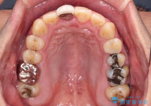 前歯のデコボコとクロスバイトをインビザライン矯正で改善の治療後