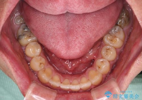 前歯のデコボコとクロスバイトをインビザライン矯正で改善の治療後