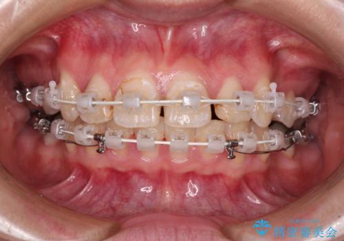 前に飛び出した前歯を治したい ワイヤー装置による抜歯矯正治療の治療中