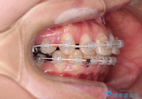 前に飛び出した前歯を治したい ワイヤー装置による抜歯矯正治療の治療中