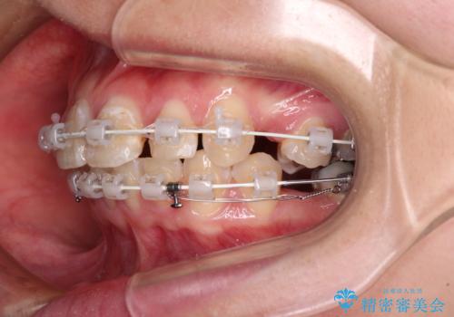 前に飛び出した前歯を治したい　ワイヤー装置による抜歯矯正治療の治療中