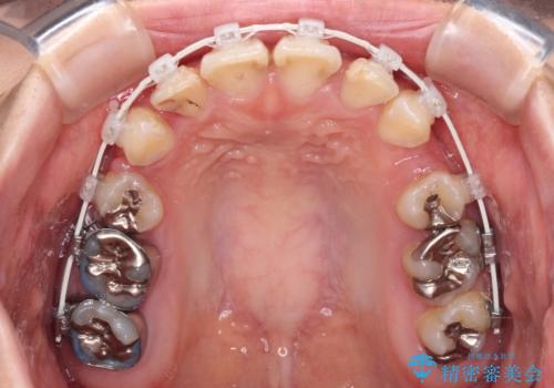 前に飛び出した前歯を治したい ワイヤー装置による抜歯矯正治療の治療中