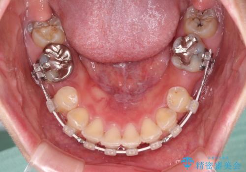前に飛び出した前歯を治したい ワイヤー装置による抜歯矯正治療の治療中