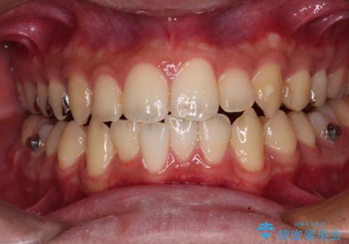 前歯のクロスバイト インビザラインによる矯正治療の治療中