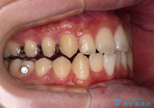 前歯のクロスバイト　インビザラインによる矯正治療の治療中