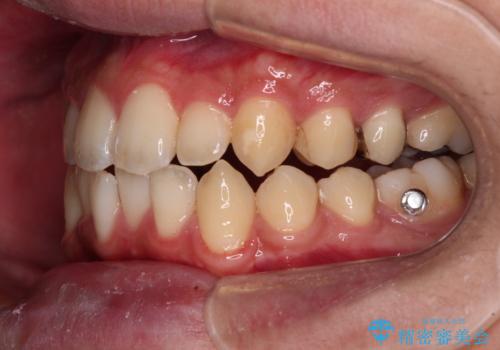 前歯のクロスバイト インビザラインによる矯正治療の治療中