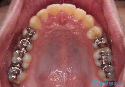 前歯のクロスバイト インビザラインによる矯正治療の治療中