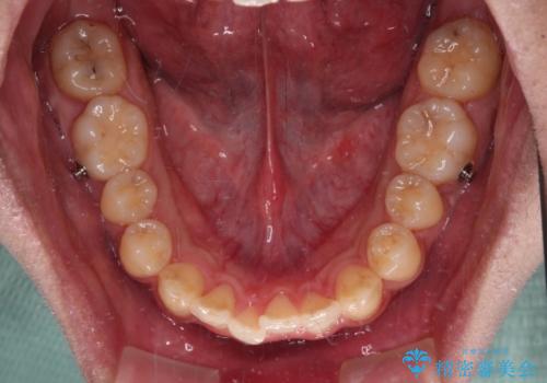 前歯のクロスバイト　インビザラインによる矯正治療の治療中
