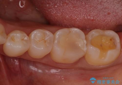 銀歯を無くしたい　セラミックインレーの治療中
