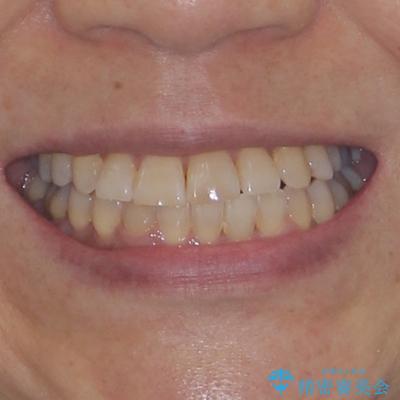 骨格のずれをカムフラージュ クロスバイトのワイヤー矯正の治療後(顔貌)