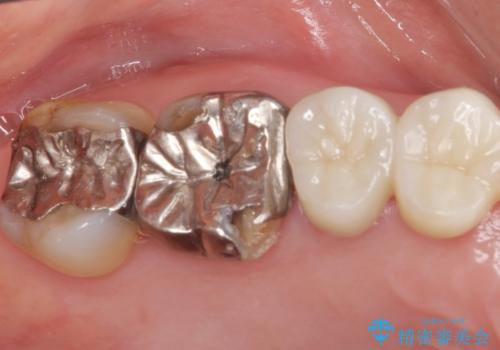 歯が欠けて染みるの症例 治療前