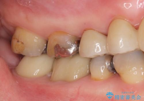 歯が欠けて染みるの治療前