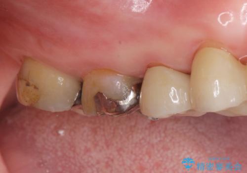 歯が欠けて染みるの治療前