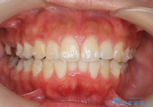 前歯の角度を改善するマウスピース矯正の治療中