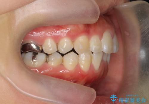 前歯の角度を改善するマウスピース矯正の治療中