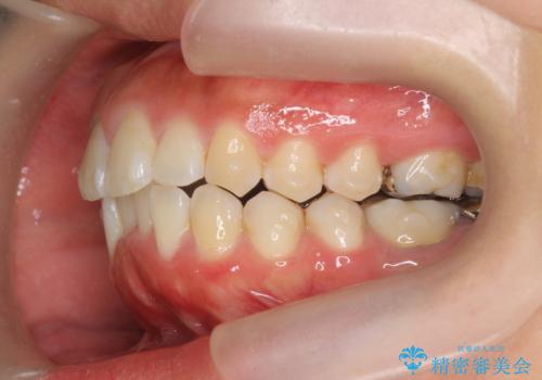 前歯の角度を改善するマウスピース矯正の治療中