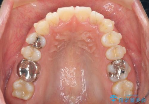 前歯の角度を改善するマウスピース矯正の治療中