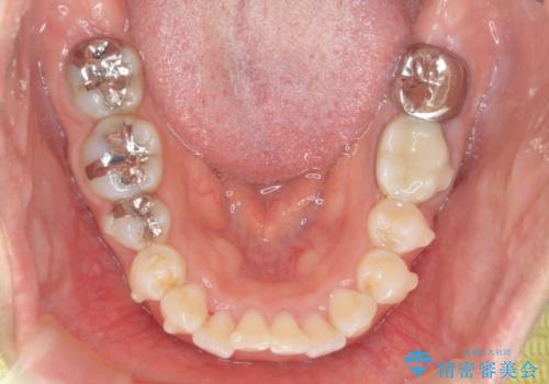 前歯の角度を改善するマウスピース矯正の治療中