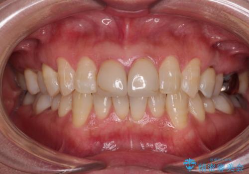 つぎはぎとグレーに透ける色が気になる 前歯のオールセラミッククラウン治療の治療前