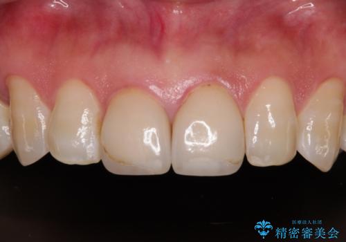 つぎはぎとグレーに透ける色が気になる 前歯のオールセラミッククラウン治療の治療前