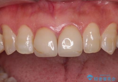 つぎはぎとグレーに透ける色が気になる 前歯のオールセラミッククラウン治療の治療前