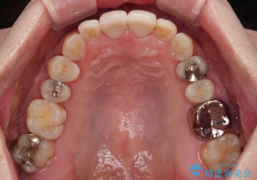 つぎはぎとグレーに透ける色が気になる 前歯のオールセラミッククラウン治療の治療前