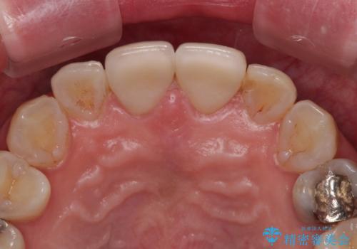 つぎはぎとグレーに透ける色が気になる 前歯のオールセラミッククラウン治療の治療前