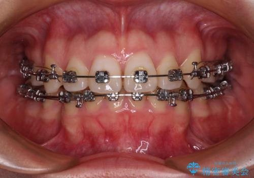 口元の突出感を抜歯矯正で改善　メタル装置で費用を抑えるの治療中