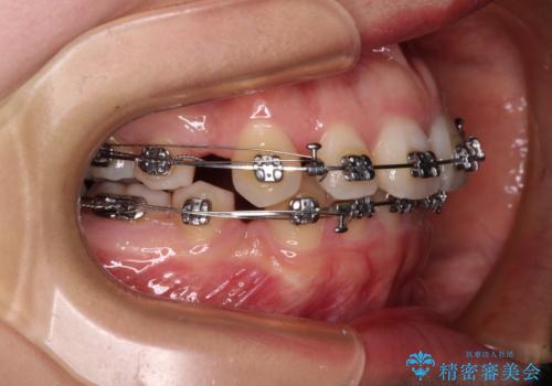 口元の突出感を抜歯矯正で改善 メタル装置で費用を抑えるの治療中