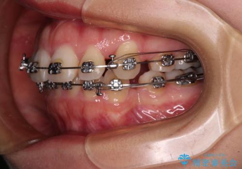 口元の突出感を抜歯矯正で改善 メタル装置で費用を抑えるの治療中