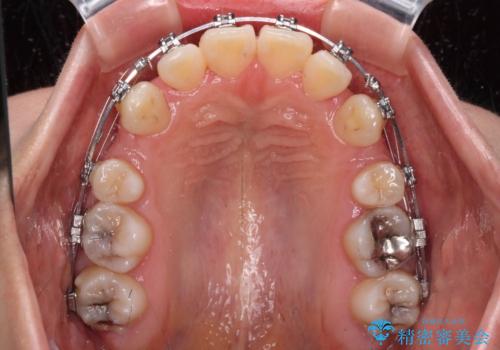 口元の突出感を抜歯矯正で改善 メタル装置で費用を抑えるの治療中
