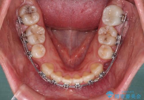 口元の突出感を抜歯矯正で改善 メタル装置で費用を抑えるの治療中