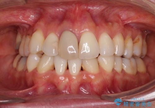 失活により変色した前歯 オールセラミッククラウンによる審美歯科治療の治療前