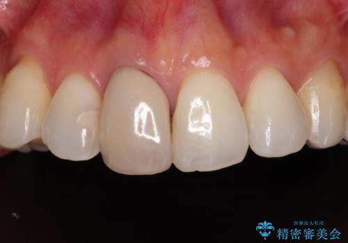 失活により変色した前歯 オールセラミッククラウンによる審美歯科治療の症例 治療前