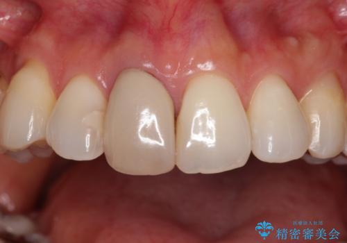 失活により変色した前歯 オールセラミッククラウンによる審美歯科治療の治療前