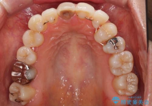 失活により変色した前歯 オールセラミッククラウンによる審美歯科治療の治療前