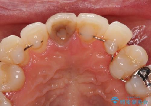 失活により変色した前歯 オールセラミッククラウンによる審美歯科治療の治療前