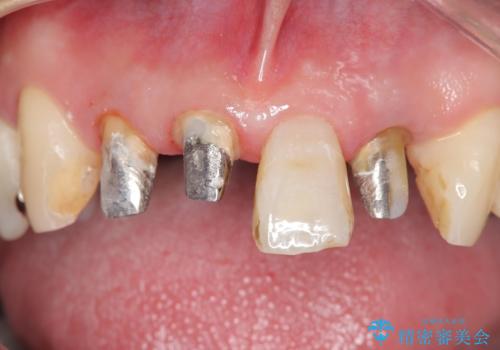【オールセラミッククラウン】被せ物の色が気になる!の治療中