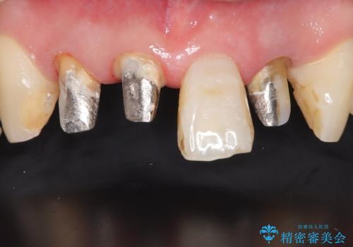 【オールセラミッククラウン】被せ物の色が気になる!の治療中