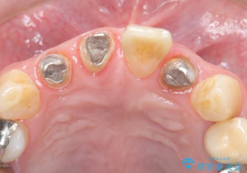 【オールセラミッククラウン】被せ物の色が気になる!の治療中