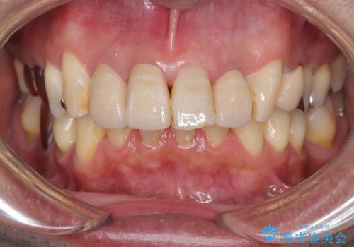 【オールセラミッククラウン】被せ物の色が気になる!