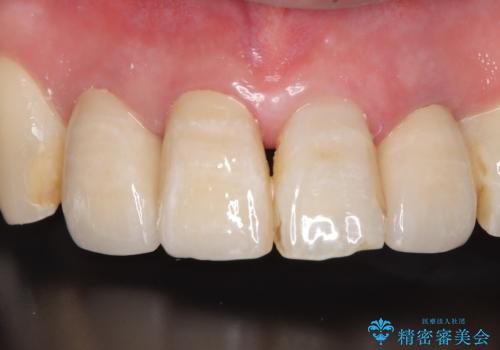 【オールセラミッククラウン】被せ物の色が気になる!の治療後