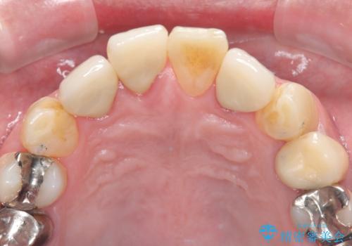 【オールセラミッククラウン】被せ物の色が気になる!の治療後