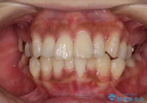 ワイヤー装置の抜歯矯正で横顔の口元の印象をすっきりとの症例 治療前