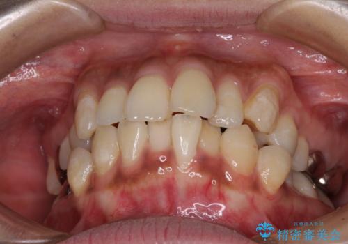 ワイヤー装置の抜歯矯正で横顔の口元の印象をすっきりとの治療前