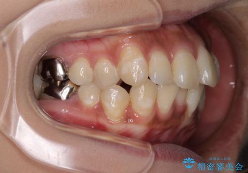 ワイヤー装置の抜歯矯正で横顔の口元の印象をすっきりとの治療前
