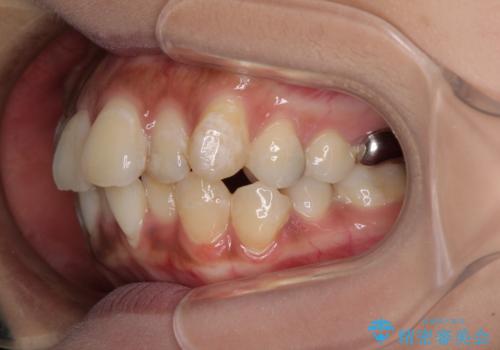 ワイヤー装置の抜歯矯正で横顔の口元の印象をすっきりとの治療前